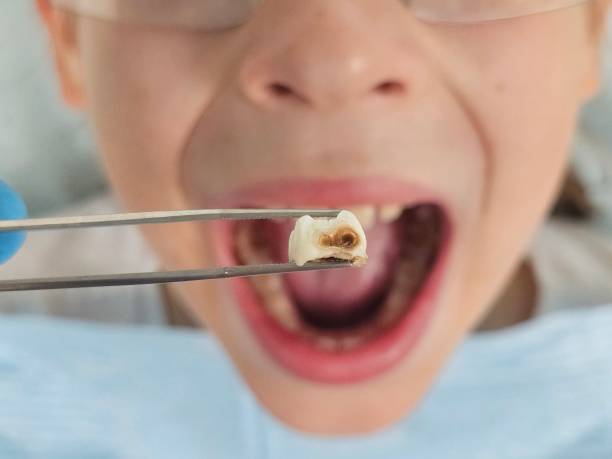 Best Emergency Treatment for Dental Infections or Abscesses in Raeford, NC